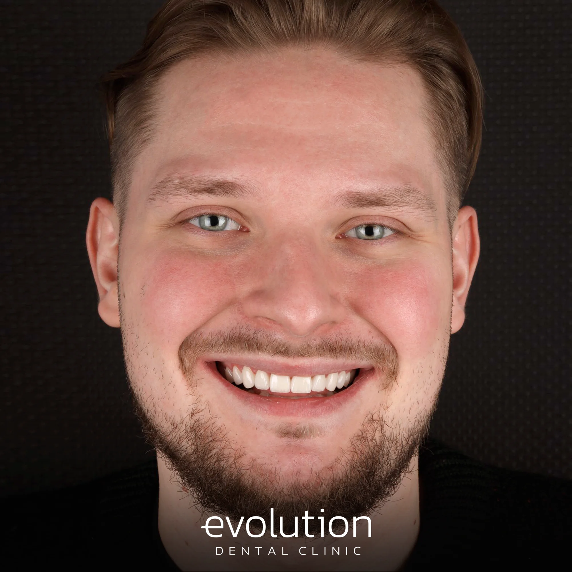 Тотальна трансформація посмішки за допомогою керамічних реставрацій.