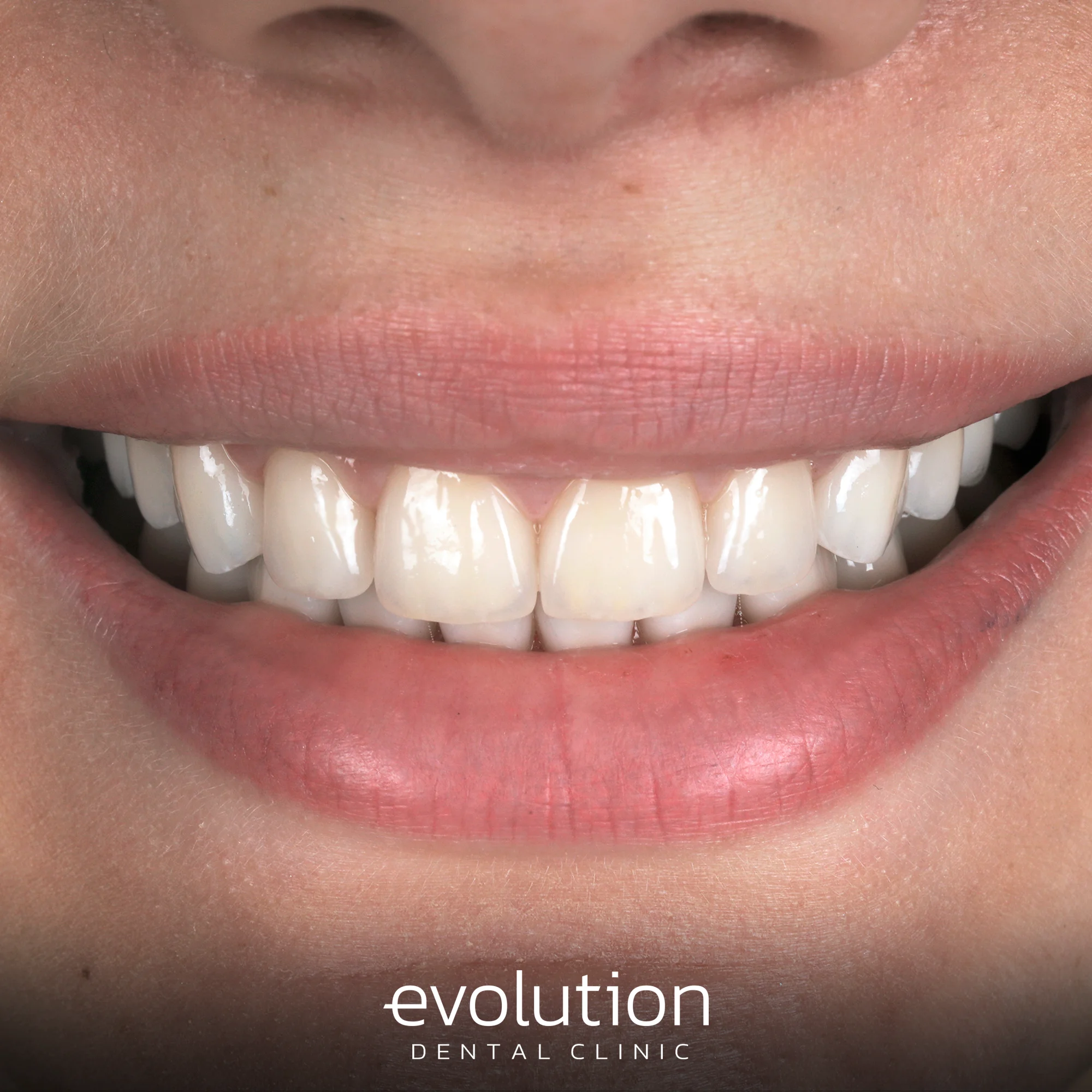 Тотальна трансформація посмішки за допомогою керамічних реставрацій.