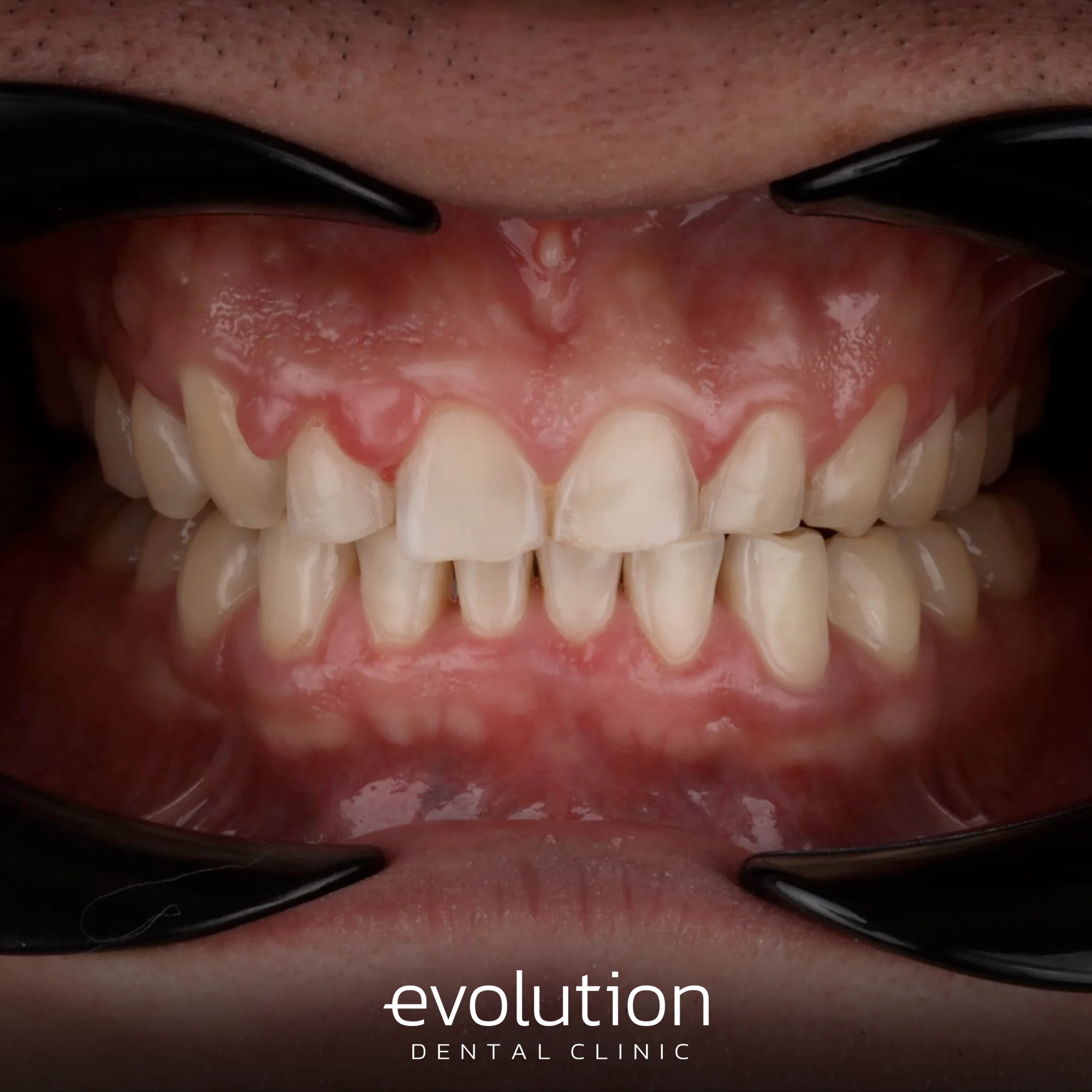 Тотальна трансформація посмішки за допомогою керамічних реставрацій.