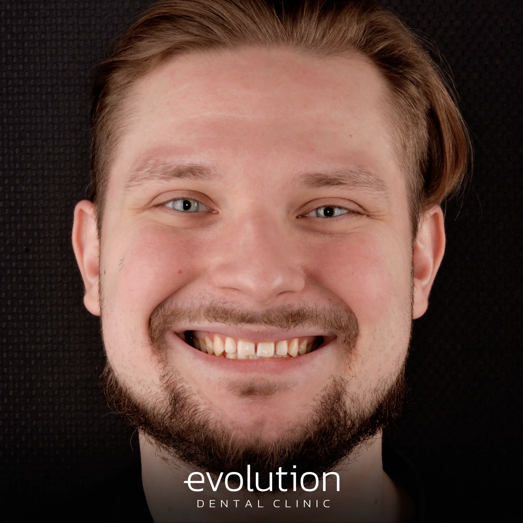 Тотальна трансформація посмішки за допомогою керамічних реставрацій.