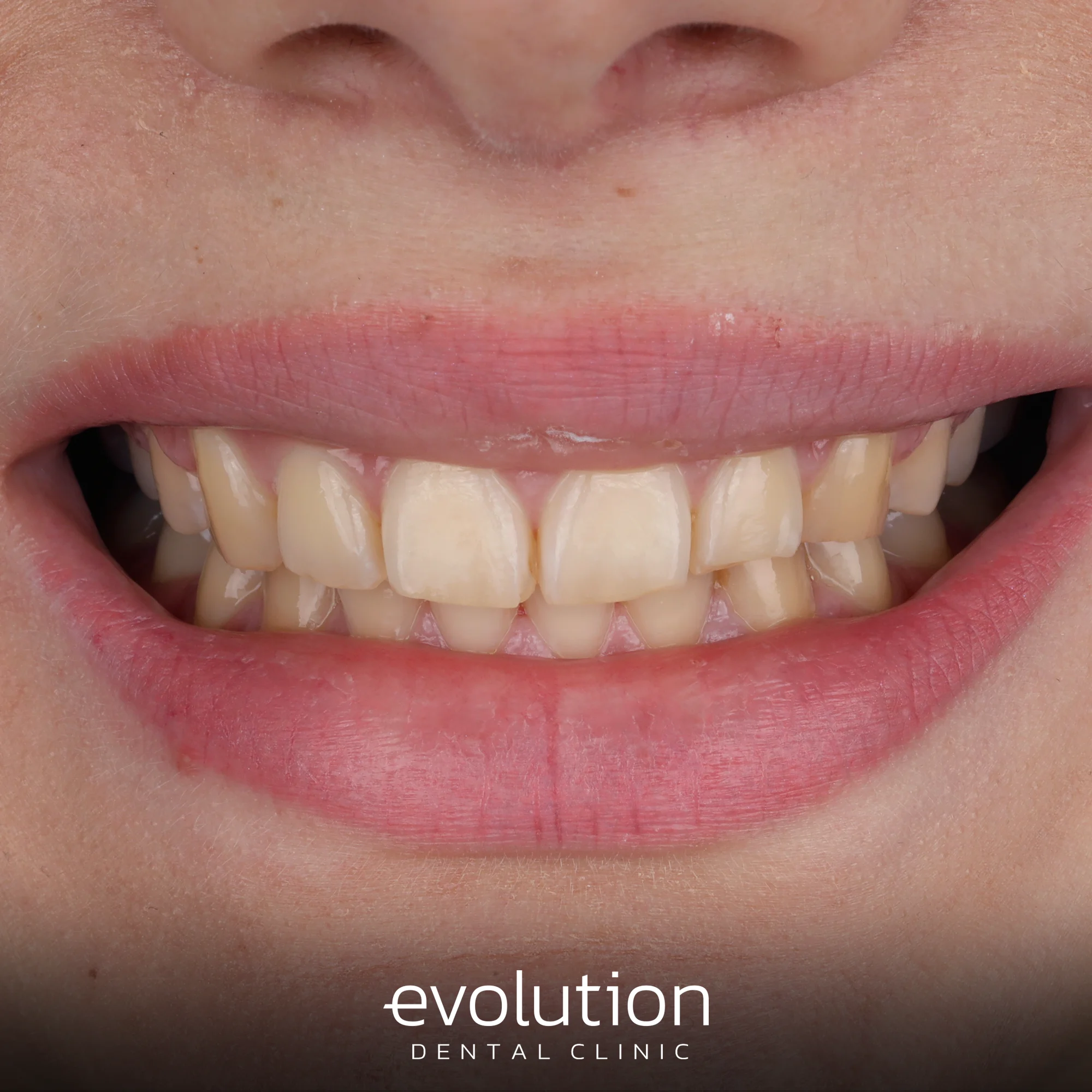 Тотальна трансформація посмішки за допомогою керамічних реставрацій.