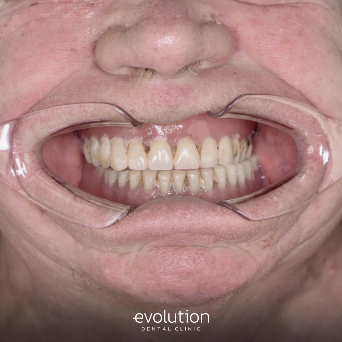 Повне знімне протезування.