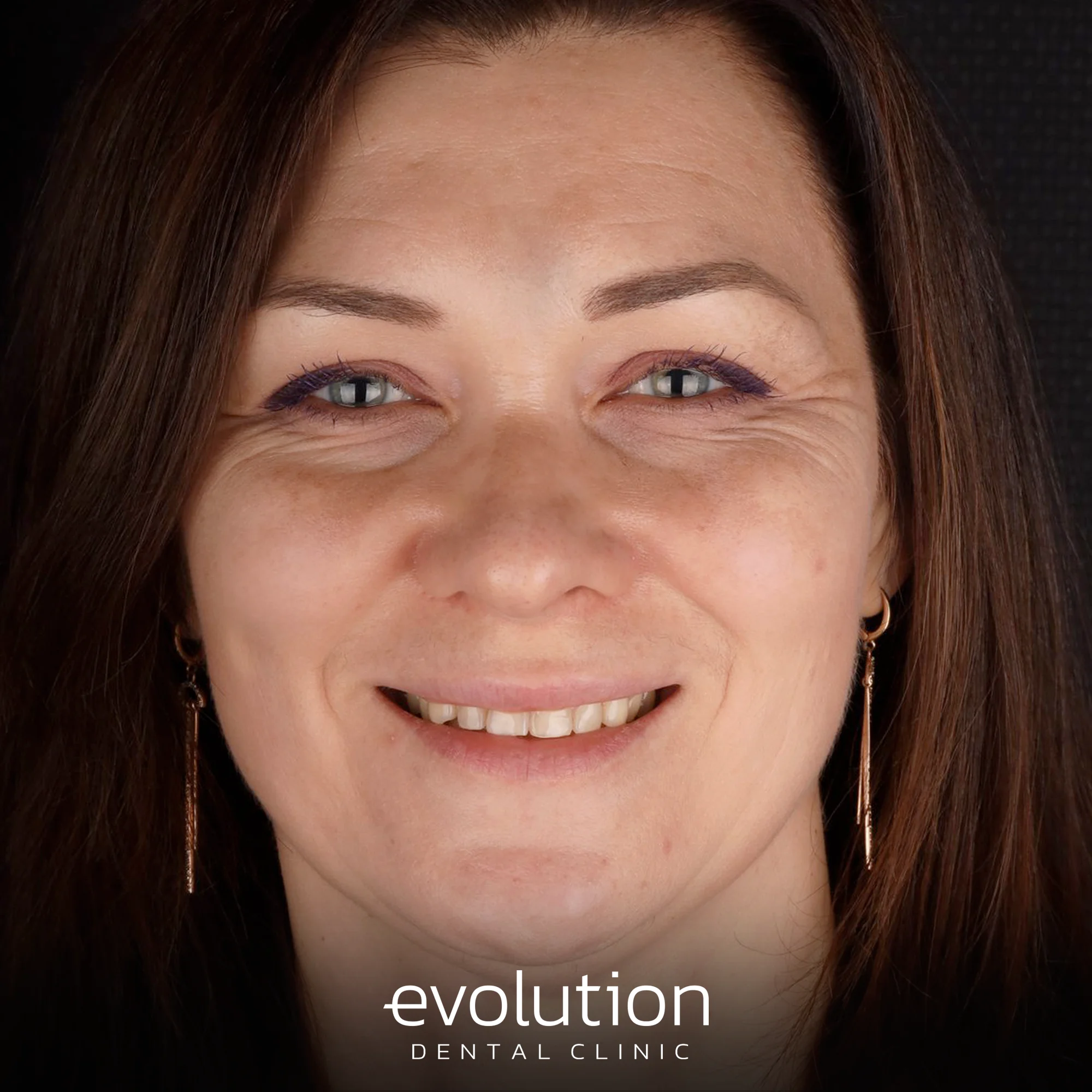 Тотальна трансформація посмішки за допомогою керамічних реставрацій.