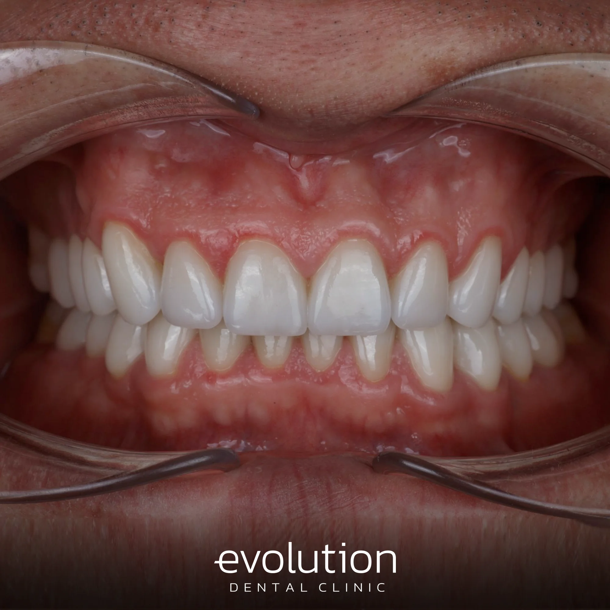 Тотальна трансформація посмішки за допомогою керамічних реставрацій.