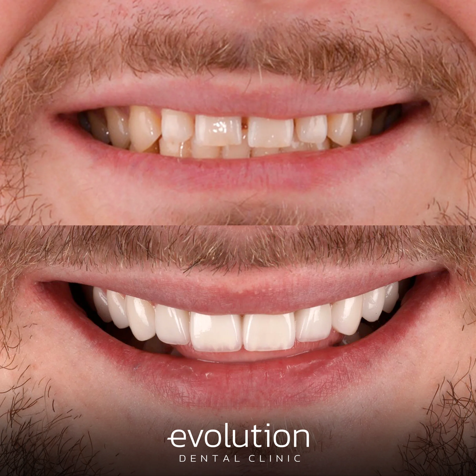 Тотальна трансформація посмішки за допомогою керамічних реставрацій.