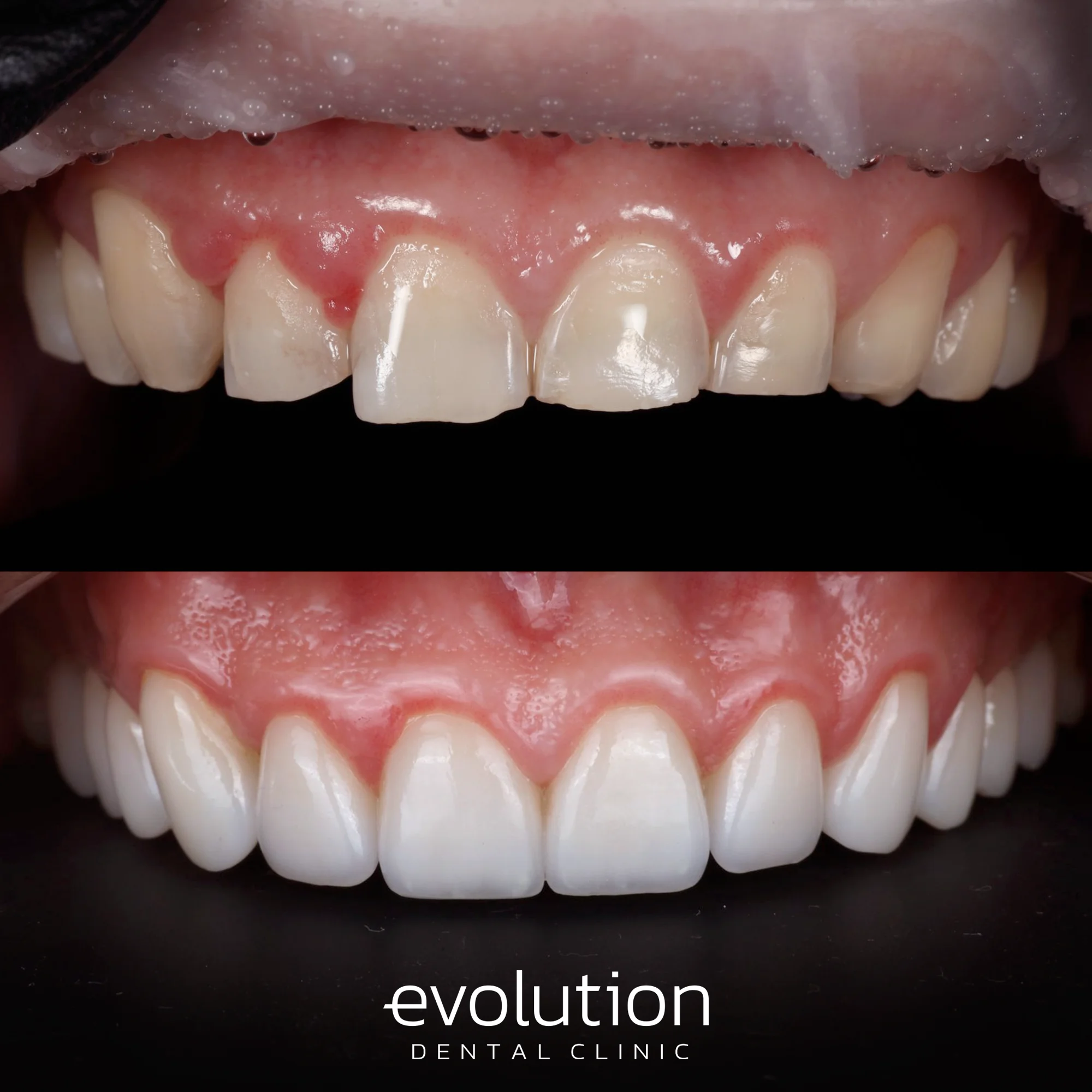 Тотальна трансформація посмішки за допомогою керамічних реставрацій.