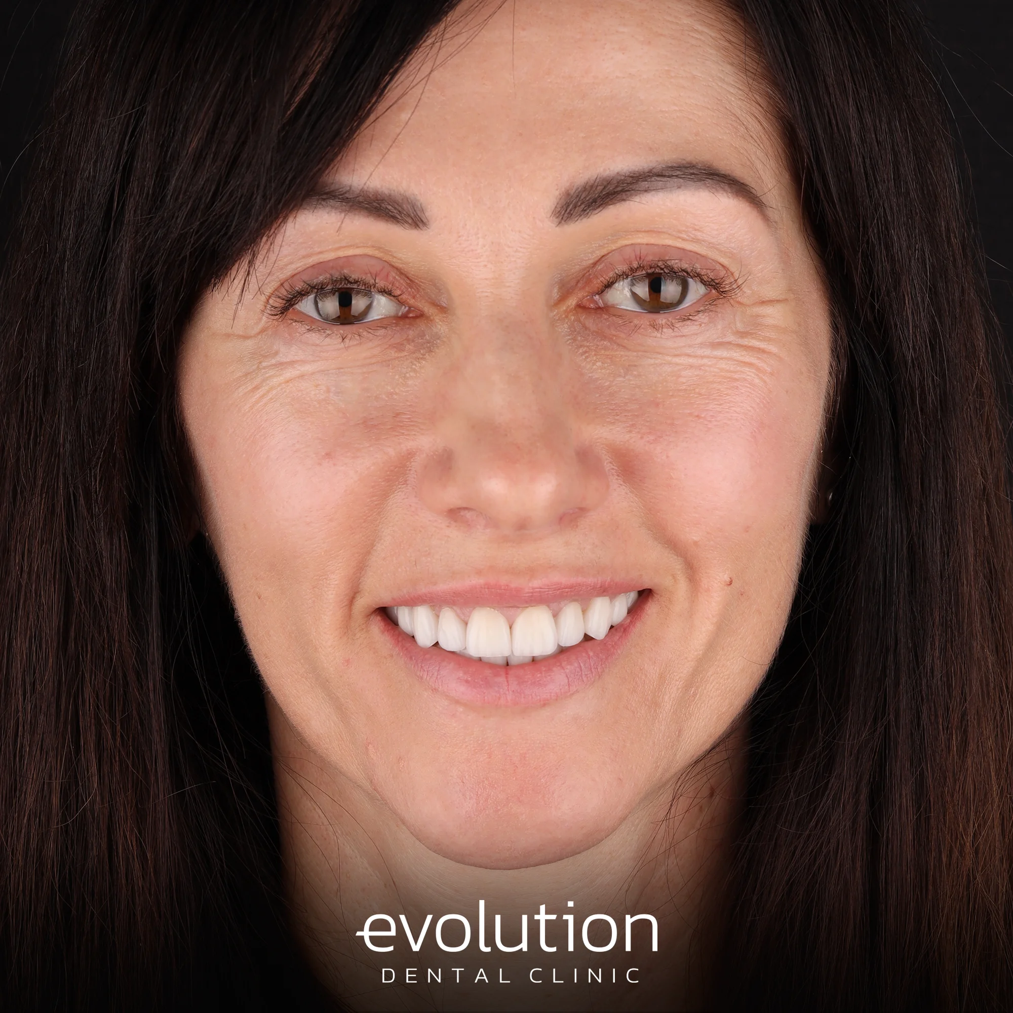 Тотальна трансформація посмішки за допомогою керамічних реставрацій.