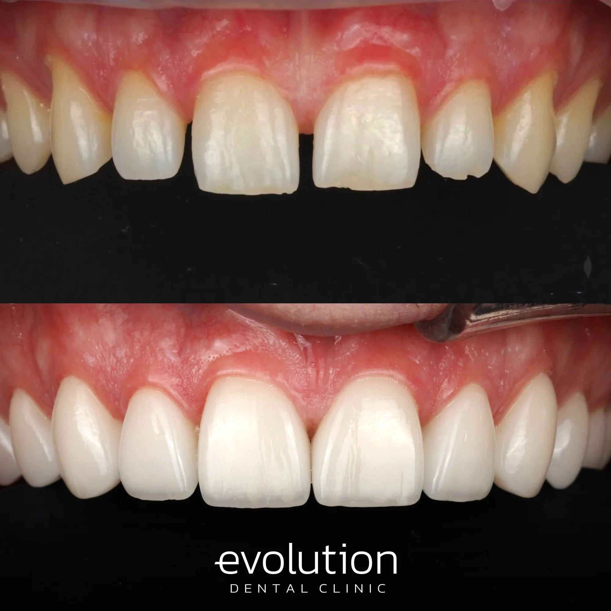 Тотальна трансформація посмішки за допомогою керамічних реставрацій.