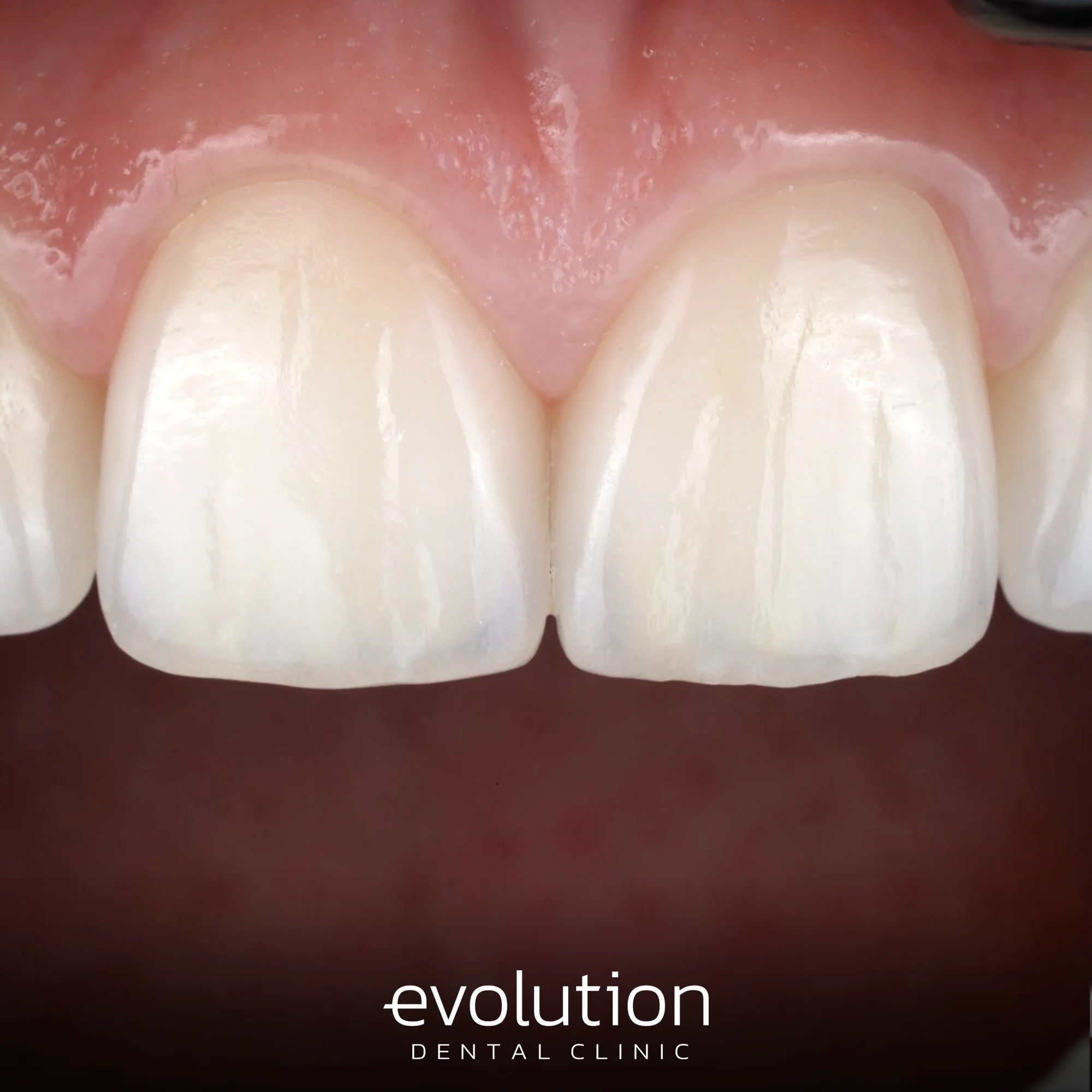 Тотальна трансформація посмішки за допомогою керамічних реставрацій.