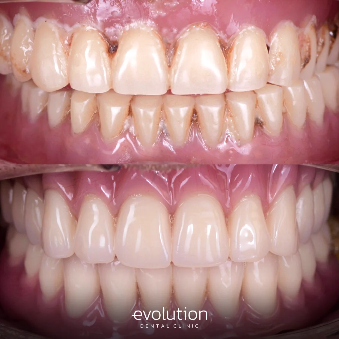 Повне знімне протезування.