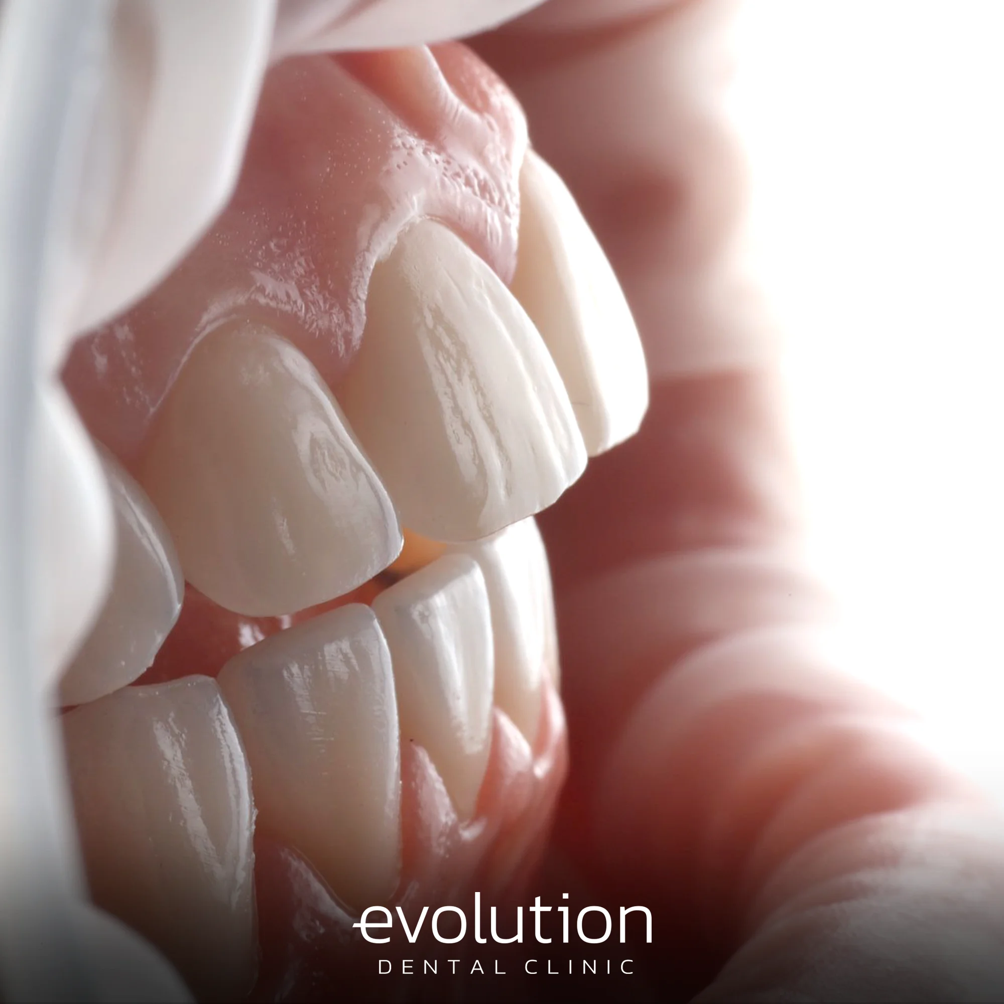 Тотальна трансформація посмішки за допомогою керамічних реставрацій.