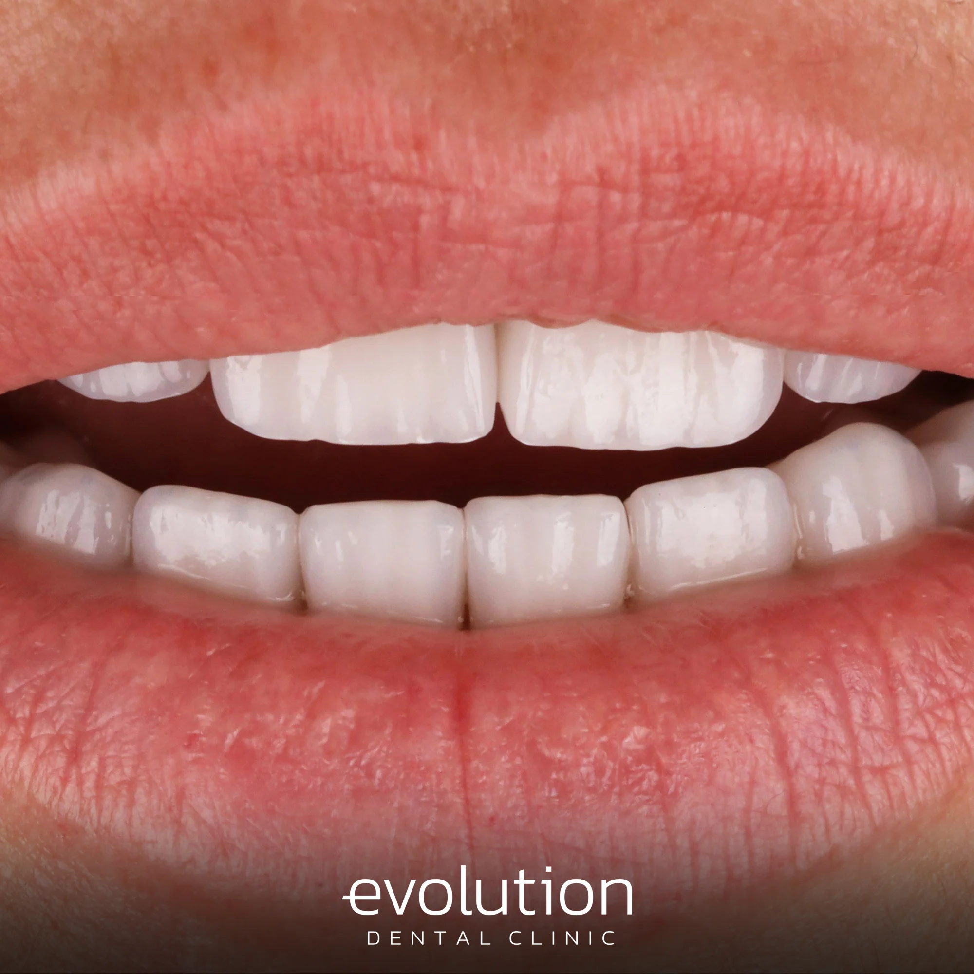 Тотальна трансформація посмішки за допомогою керамічних реставрацій.