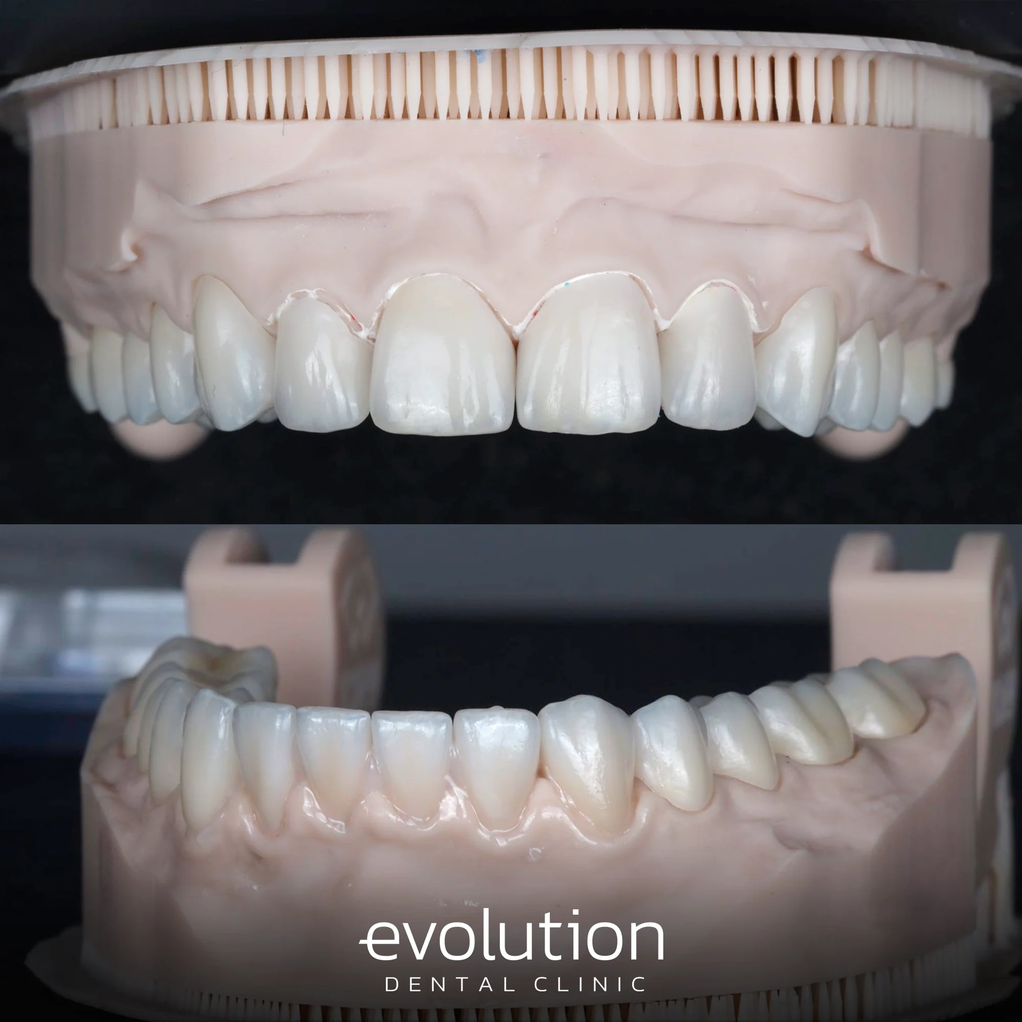 Тотальна трансформація посмішки за допомогою керамічних реставрацій.